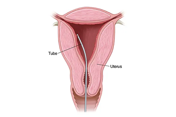 Rahim İçinden Parça Alınması (Endometrial Biyopsi )