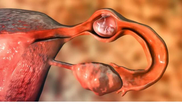 Ektopik Gebelik (Dış Gebelik)