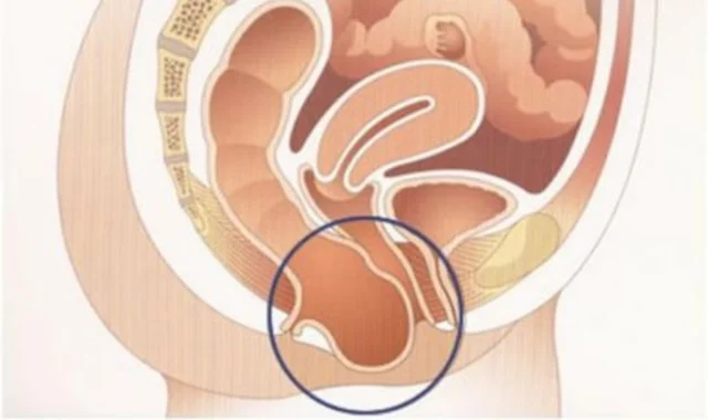 Rektosel ve Enterosel