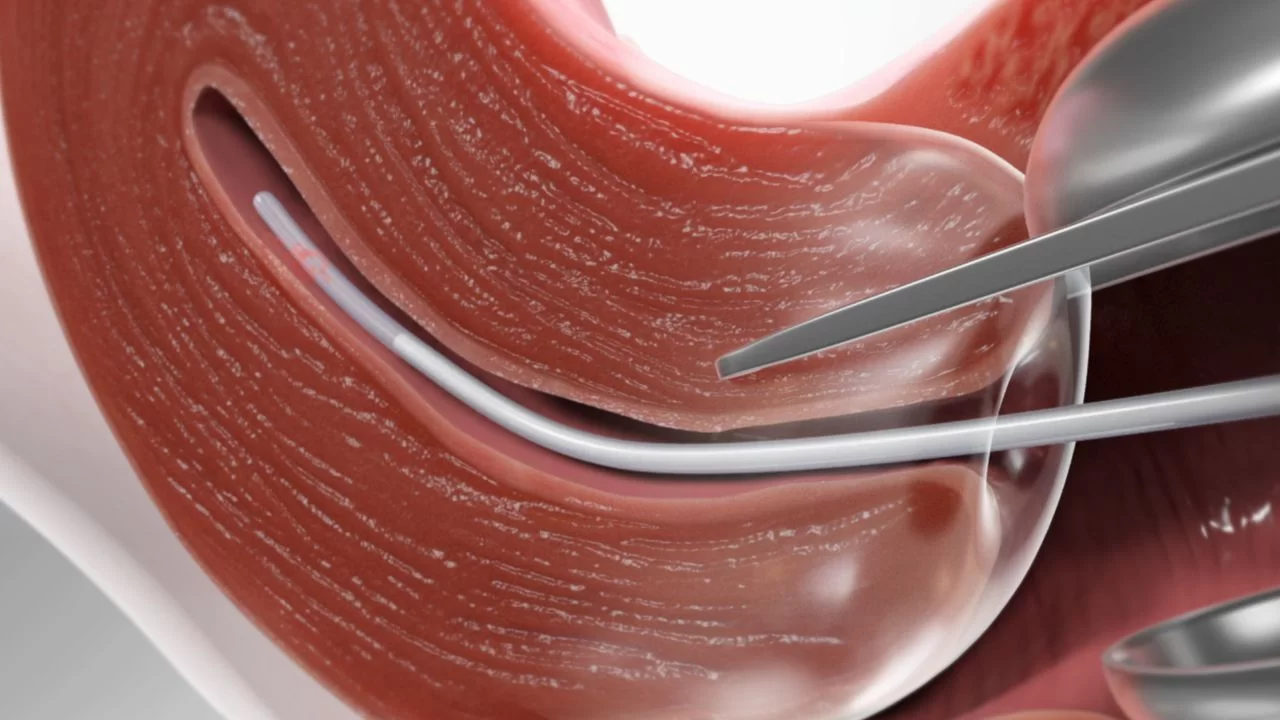 Endometrioma ( Çikolata Kistleri ) - Endometriozis